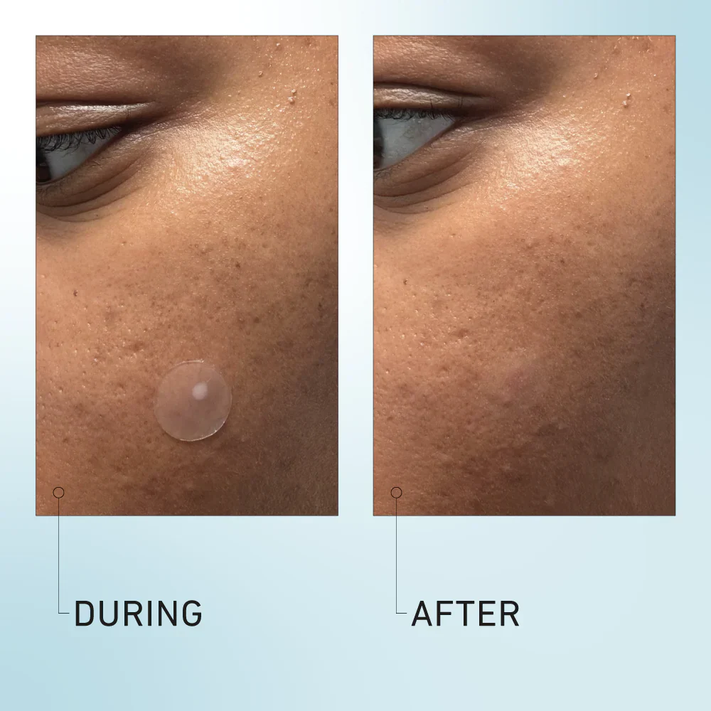 Good Light Luna Pimple Patches - Image 3