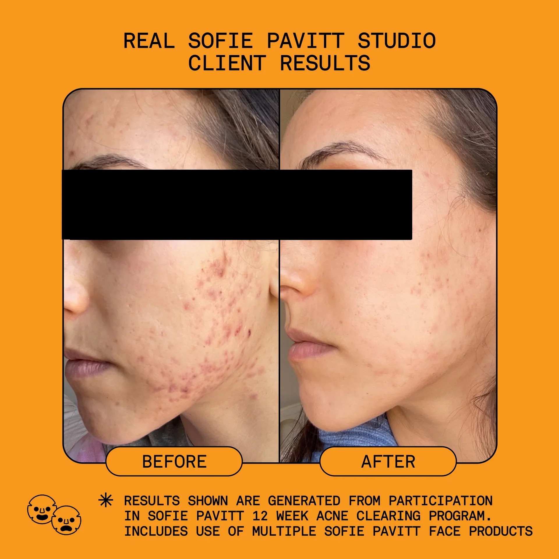 Sofie Pavitt Face Reset 5% Benzoyl Peroxide Acne Treatment - Image 4